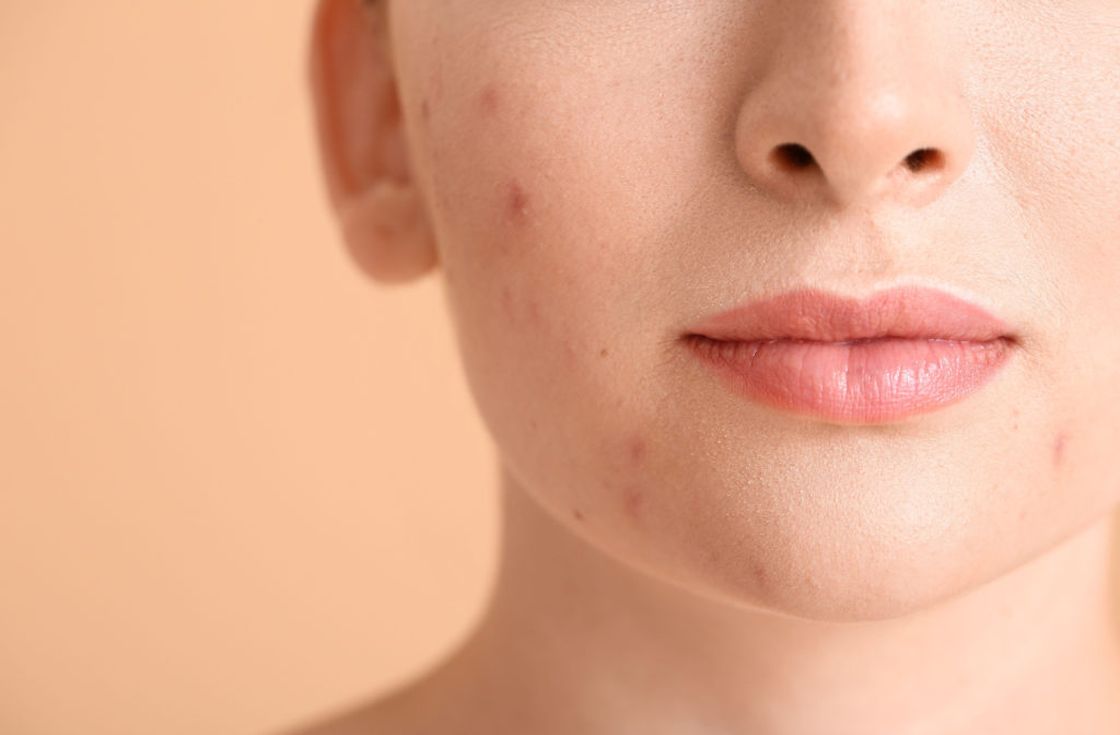 A close-up of a woman with acne on her lower half of her face.