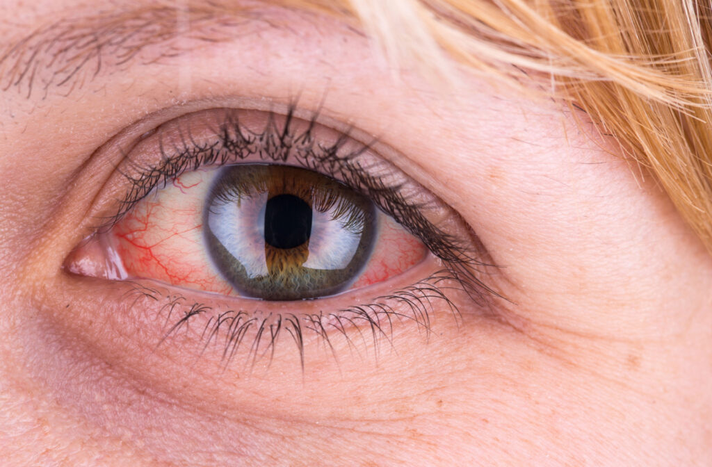 A close-up of a bloodshot eye caused by dry eye.