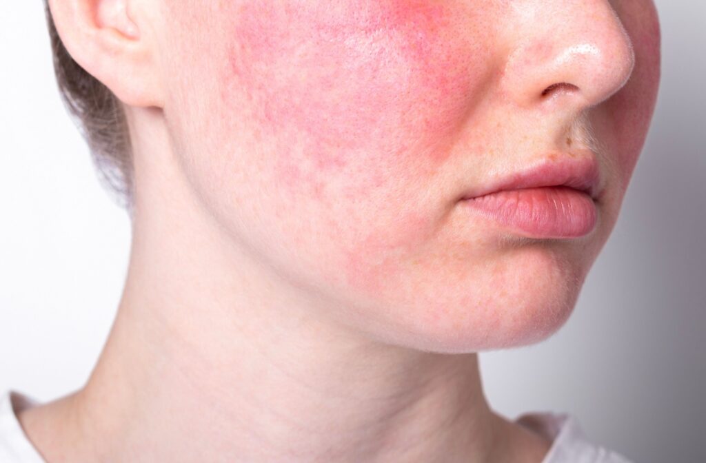 A close up photot of a person suffering from rosacea on their cheeks.