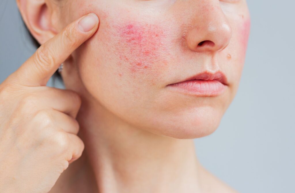 A person showing the rosacea on their cheeks